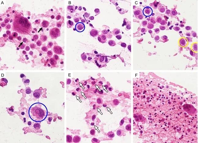 Figure 2. Squash cytological findings of LCH. A. LCs displayed centrally or eccentrically located, oval or retiform,  grooved or contorted nuclei (black arrows), and were admixed with inflammatory background