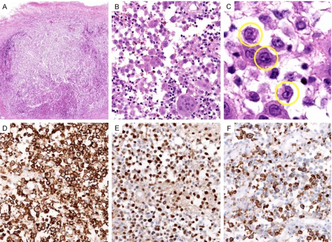 Figure 3. Histological (A-C) and immunohistochemical (D-F) findings of LCH. (A) At low power, diffuse infiltration of  LCs was noted