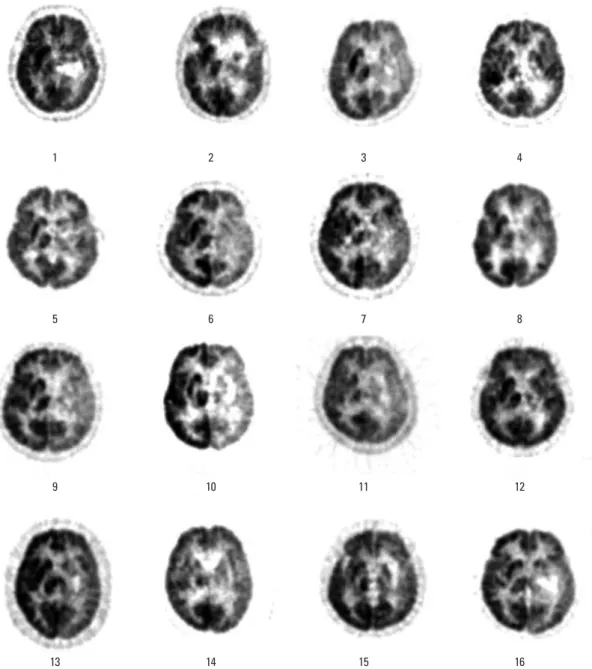 Table 5 demonstrates the difference in the brain metabo- metabo-lism between the normal controls and the patients with  flu-ent subcortical aphasia
