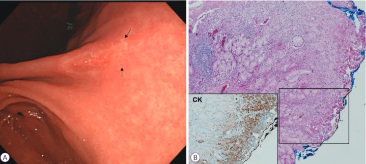 Fig. 1. Signet ring cell carcinoma (SRC) case with positive lateral margin after endoscopic resection