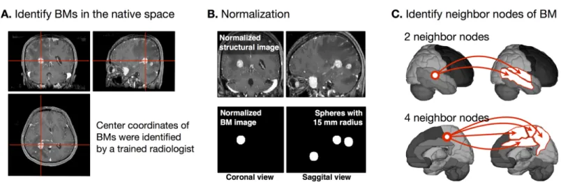 Fig 1. Flowchart for mapping brain metastases (BMs) in the standardized automated anatomical labeling (AAL) template space
