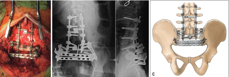 Table 4.  Surgical Management of Patients with Sacral Tumor