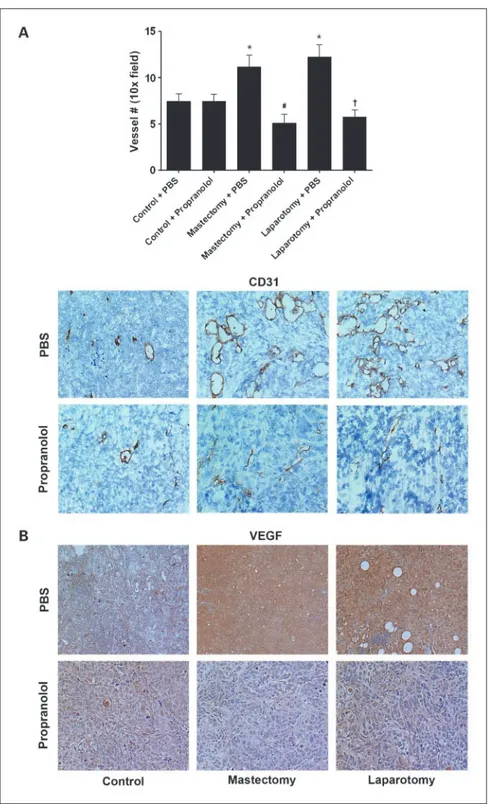 Fig. 4. The effect of propranolol on angiogenesis in surgically stressed mice. SKOV3ip1tumor samples obtained from control or surgically stressed mice were treated with placebo (PBS) or propranolol pump and stained for CD31 (A) and VEGF (B) by immunohistoc