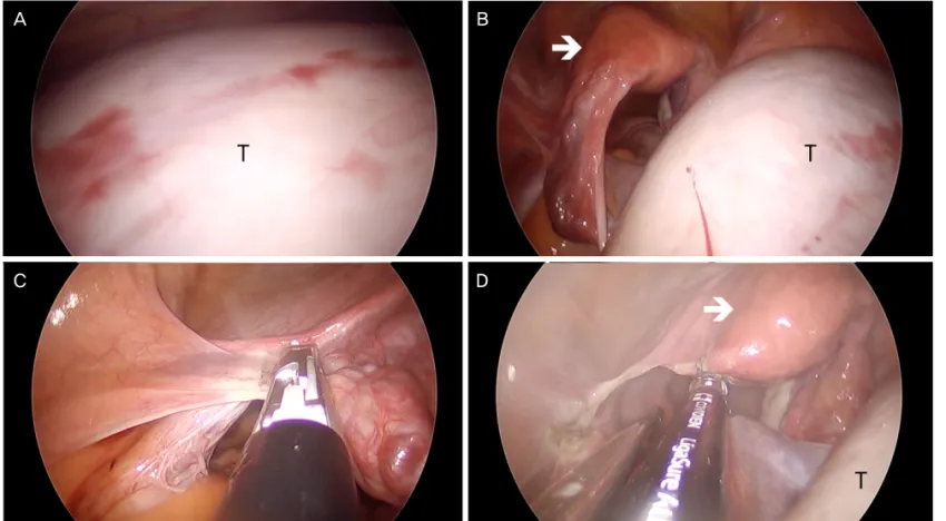 Fig. 2.  Intraoperative view of single-port laparoscopic surgery in a patient with a large left ovarian cyst tumor