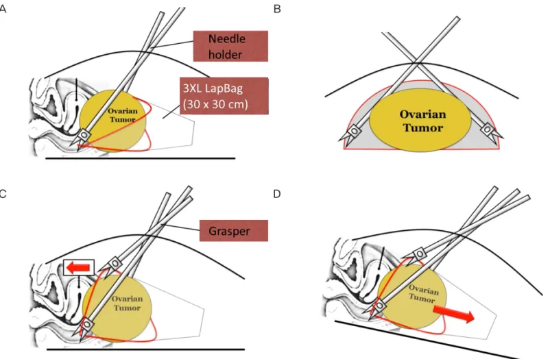 Fig. 3.  SW Kim’s technique for placing a large tumor in a laparoscopic bag (3XL LapBag)