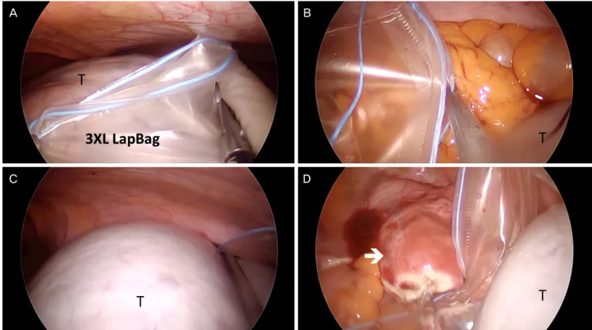 Fig. 4.  Intraoperative view of SW Kim’s technique for placing a large tumor in a laparoscopic bag (3XL LapBag)
