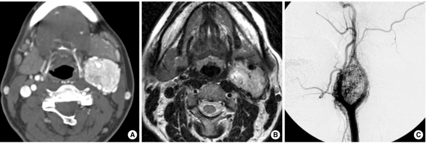 Fig. 1. A 35-yr-old woman with a characteristic carotid body paraganglioma. (A) Axial contrast-enhanced CT shows an avidly enhancing mass splaying the external carotid artery (ECA) and internal carotid artery (ICA) at the left carotid bifurcation