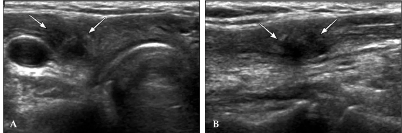 Fig. 3. A, B. Coronal (A) and Axial view (B). A few foci of mildly increased FDG uptake are seen in the right thyroidectomy area.