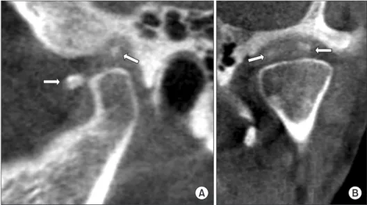 Fig. 3. Cone-beam computed tomo- tomo-graphic images after 1 year and a half.  (A) Sagittal view, (B) coronal view