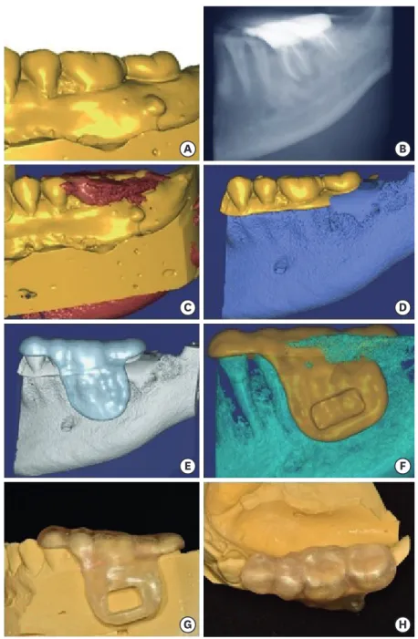 Figure 2.  (A) Scanning data of the cast. (B) Cone-beam computed tomography (CBCT) image of the tooth  uploaded to the surgical planning software