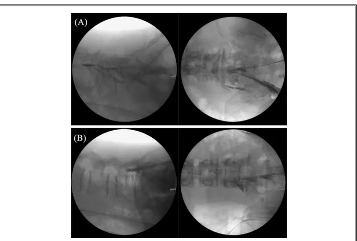 Fig. 1. Epidurography pattern of  lumbar PEN with a ventral-positioned catheter (A): more localized selective block in the 