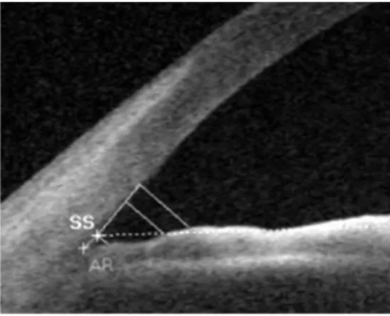 Figure 2 Scleral spur (SS), angle recess (AR) and 500/750 µm  points from scleral spur were indicated in analyzed program.