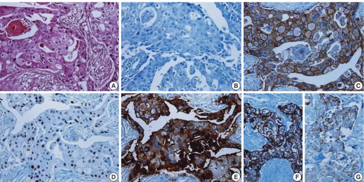 Fig. 1. Histologic and immunologic features of molecular apocrine breast cancer (MABC)