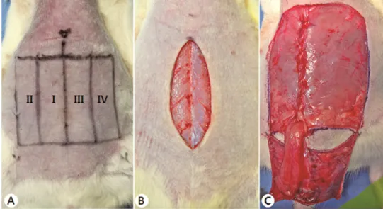 Figure 1. Transverse rectus abdominis musculocutaneous (TRAM) flap design  and surgical protocol.
