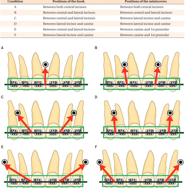 Table 2. Positions of the hooks and miniscrews for the intrusion of the maxillary anterior teeth
