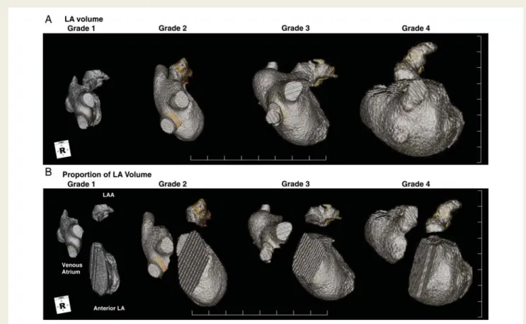 Figure 1 (A) Right lateral views of left atrium in the reconstructed three-dimensional spiral computed tomography image depending on the degree of left atrial remodelling