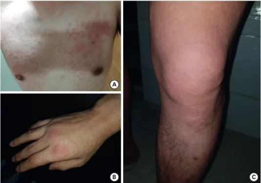 Fig. 1.  Urticaria on the trunk (A), hand (B) and leg with joint swelling (C) of the patient in case 1.