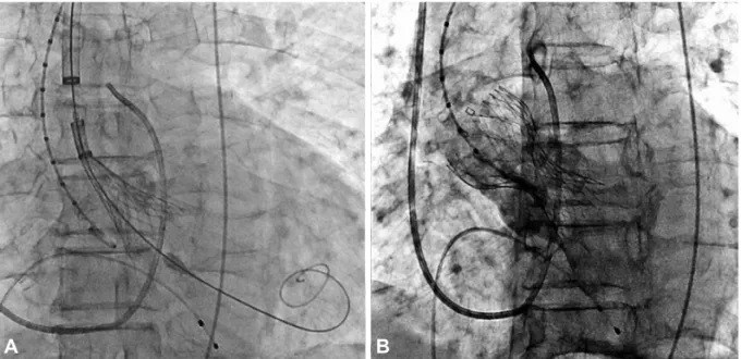 Fig. 4.  CoreValve delivery catheter and bioprosthetic valve deployed across the aortic valve (A) and spontaneously expanded