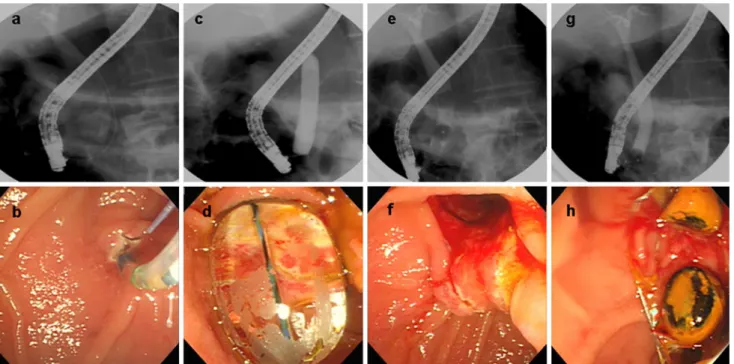 Fig. 2 The angle of the distal common bile duct (CBD) with the horizontal plane. The angle of the distal CBD was measured as the angle between the inflated balloon at the ampulla and the horizontal plane of the vertebra (black lines)