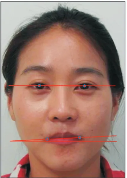 Figure 1. Measurement of lip-line cant using an image  analyzer. Using the software, the degree of lip-line cant  was evaluated by measuring the angles between the  interpupillary line and the intercommissure line.