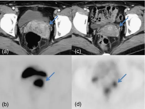 Fig. 3 Axial images of contrast- contrast-enhanced abdominal CT (a) and PET (b) show an enhancing uterine cervical mass (SUVmax 30.6)