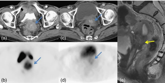 Fig. 4 Axial images of contrast-enhanced abdominal CT (a) and PET (b) show an enhancing uterine cervical mass (SUVmax 8.5)