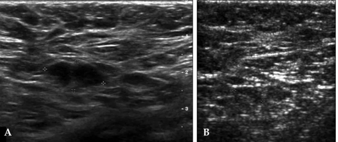 Fig 3. A 40-year-old woman with left modified radical mastectomy 5.5 years ago. (A) Post-op follow up ultrasonography shows eccentric cortical thickening of the contralateral axillary lymph node, which was proved to be the metastatic lymph node by the core