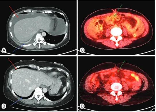 Figure 1. Histopathologic ﬁndings of well-differentiated papillary mesothelioma (WDPM) from the representative patient (Case 12)
