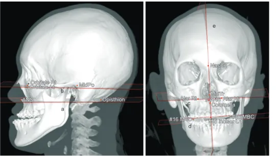 Figure 3. Horizontal and sag- sag-ittal planes associated with  the midface. a, His’ plane; b,  Frankfort horizontal plane;  c, Camper’s plane; d, occlusal  plane; e, nasal axis plane