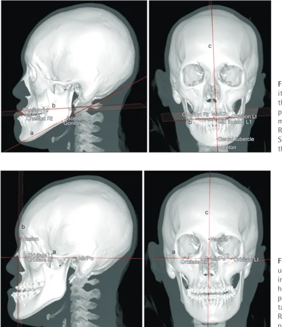 Figure 4. Horizontal and sag- sag-ittal planes associated with  the lower face. a, Mandibular  plane; b, lip canting plane; c,  mandibular symmetry plane
