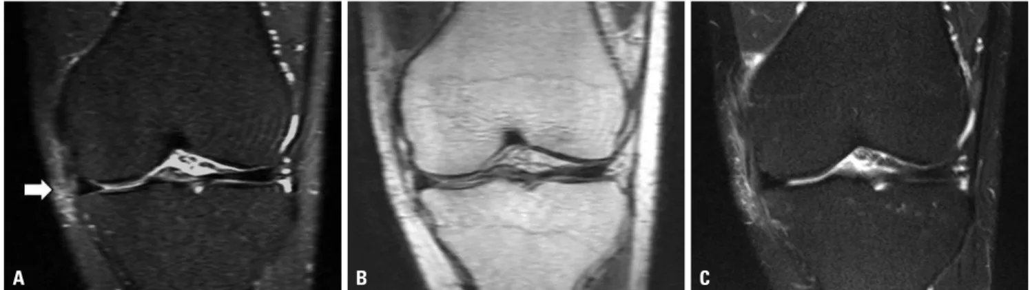 Fig. 4.  (A) Metal artifact posterior to the proximal tibial cortex in 3D FSE- FS image
