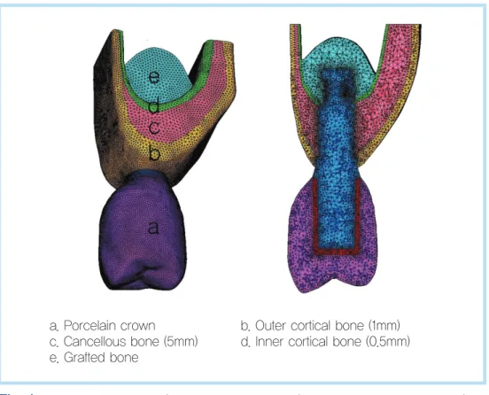 Fig. 1.  Finite Element model ( Example in case of C/I ratio 1.0, 5.75mm bone level).