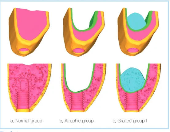 Fig. 2.  Classification of models according to cancellous bone quantity.