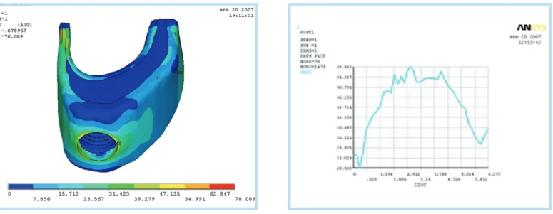 Fig. 6.  Von Mises stress value around implant in atrophic group.