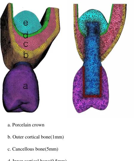 Figure 1. Finite Element model ( Example in case of C/I ratio 1.0, 6.5mm bone level). 