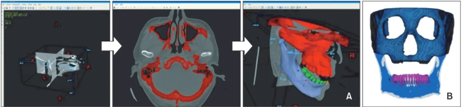 Figure 1. Segmentation and 3-dimensional surface generation with Bionix program (A) and finite element model 