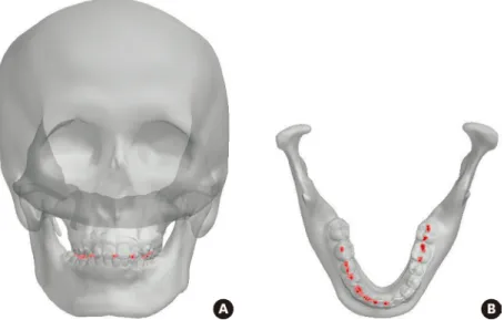 Figure 2.  The reproduction of occlusion contacts (red colored area) at the time of initial contact on both sides  during the closing phase of lateral movement