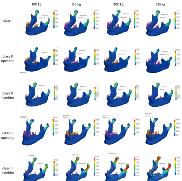 Figure 3.  Stress distribution with simulation of lateral movement with 100, 150, 200 and 225kgf loading force in cases I~V.