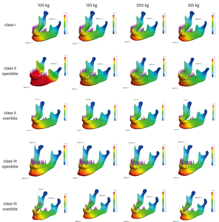 Figure 4.  Distortion of mandible with simulation of lateral movement with 100, 150, 200 and 225kgf loading force in cases I~V.