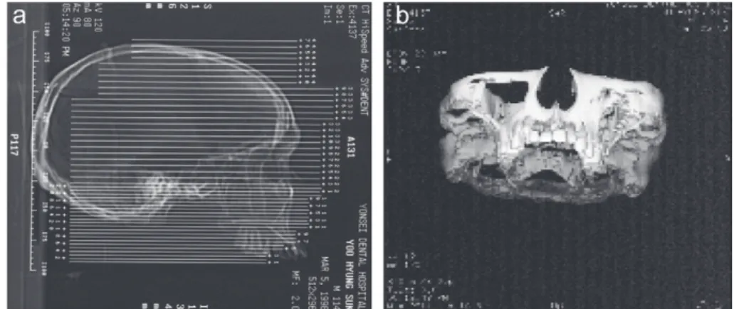 Figure 1  Computerized tomograph of (a) the dry skull and (b) three-dimensional reconstruction of the 