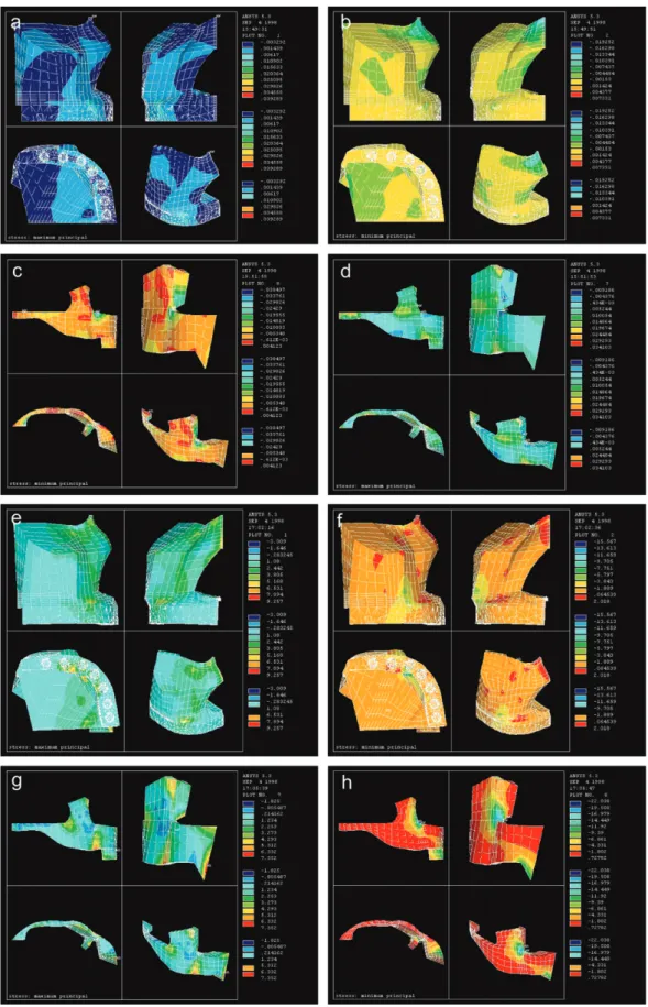 Figure 6  The maximum tensile (left) and compressive (right) stress distributions in simulations A and B for the maxilla (a and b, e and f, respectively) 