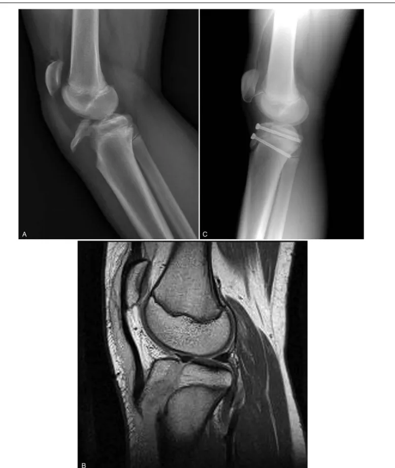 Figure 2. (a) A 12-year-old boy (No. 11) fell down during Taekwondo. Ogden type IIIA tibial tubercle avulsion fracture was noted