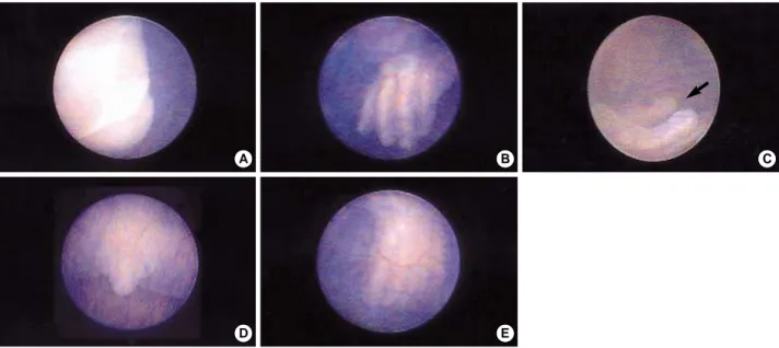 Fig. 2. Embryofetoscopic view of the fetus at 13 +5 weeks gestation demonstrating normal anatomical structures: ( A ) lips, ( B ) four fingers of left hand, ( C ) thumb of left hand, ( D ) external genitalia and ( E ) toes.
