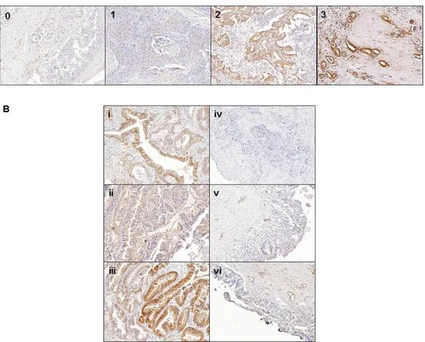 Figure 8. Representative IHC staining of TAGLN2 and the comparison in  human  BTC  tissues  and  normal  bile  duct  tissues  within  individual  patients