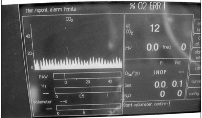 Fig.  2.  Capnography  monitoring  with  the  proximal  lumen  of  a  two-lumen  central  venous  catheter  during  jet  ventilation.