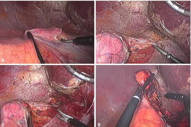 Fig. 2. Operative findings of case 1. (A) The retroperitoneum covering the adrenal gland and inferior vena cava was incised using the ar-