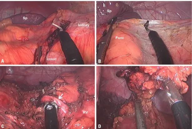 Fig. 4. Operative findings of case 2. (A) The white line of Toldt was dissected using an articulating laparoscopic hook coagulator with an 