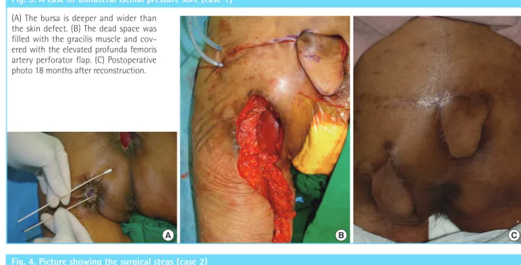 Fig. 3. A case of unilateral ischial pressure sore (case 1)