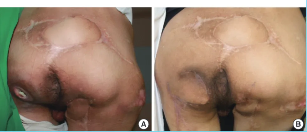 Fig. 5. A case of bilateral ischial pressure sore (case 3)