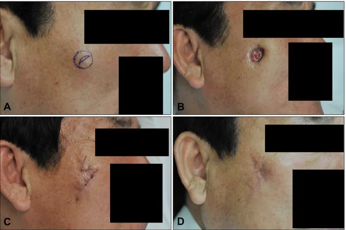 Fig. 4. Serial photographs of a representative patient (case no. 2) treated with the surgical approach